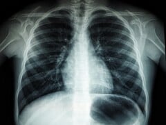 Uma imagem de raio X de um torso humano (Fonte da imagem: Umanoide via Unsplash; cortada)