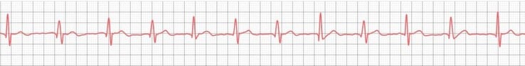 Mesmo os relógios inteligentes mais baratos já demonstraram que são capazes de registrar ECGs básicos com sucesso