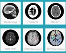O software de IA médica BrainSee da Darmiyan pode detectar sinais de Alzheimer logo no início. (Fonte: Darmiyan)