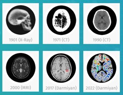 O software de IA médica BrainSee da Darmiyan pode detectar sinais de Alzheimer logo no início. (Fonte: Darmiyan)