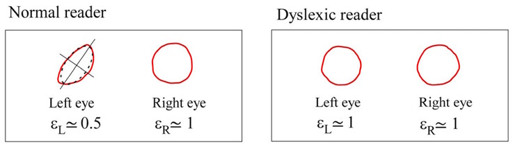 Os centroides de Maxwell diferem em simetria em indivíduos normais, mas são semelhantes em indivíduos disléxicos. (Fonte da imagem: DOI 10.3390/brainsci13101478) 