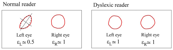 Os centroides de Maxwell diferem em simetria em indivíduos normais, mas são semelhantes em indivíduos disléxicos. (Fonte da imagem: DOI 10.3390/brainsci13101478)