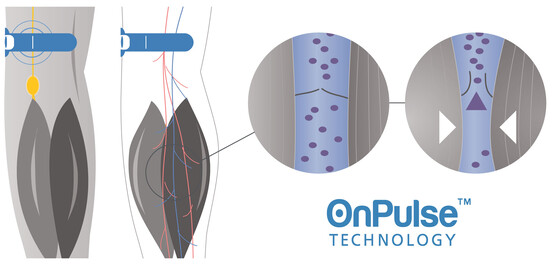 OnPulse (Fonte de imagem: Sky Medical)